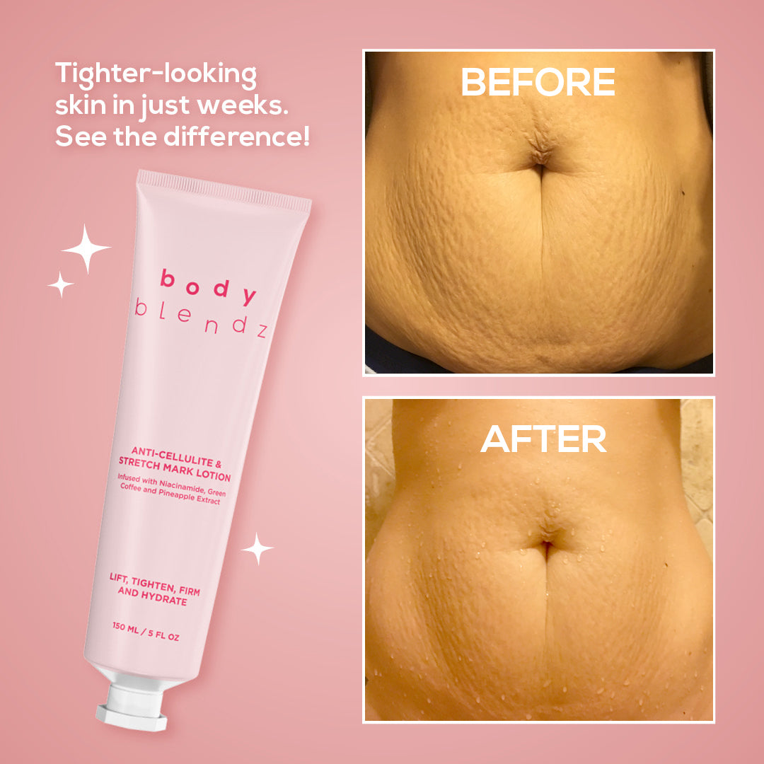Anti-Cellulite & Stretch Mark Lotion
